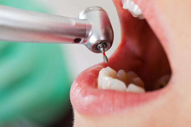 Best Emergency Tooth Extraction in Sacramento, CA